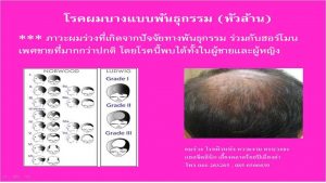 หัวล้าน ผมร่วง ผมบาง โรคผมบางจากพันธุกรรม