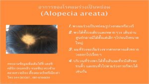 ผมร่วงเป็นหย่อม โรคผมร่วงเป็นหย่อม (Alopecia areata)