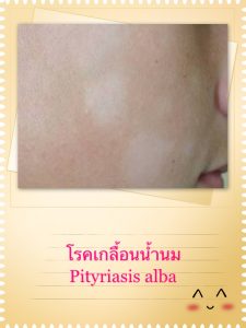 โรคเกลื้อนน้ำนม (Pityriasis alba) คืออะไร ปัจจัยเสี่ยง อาการ การรักษา