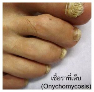 โรคเชื้อราที่เล็บ (Onychomycosis) สาเหตุ อาการ การรักษา และการป้องกัน