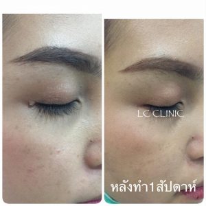 รีวิว ผ่าตัดเล็ก ก้อน ติ่งเนื้อ ไฝ ที่ใบหน้า