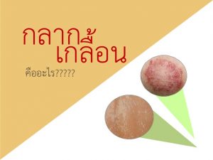 โรคกลาก เชื้อราที่ผิวหนัง อาการ สาเหตุ การวินิจฉัย และการรักษา