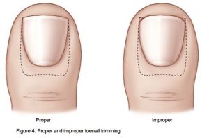 เล็บขบ (Ingrown nail) เกิดจากอะไร รักษายังไงดีน่า