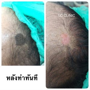 กระเนื้อ (Seborrheic Keratosis) คืออะไร สาเหตุ อาการ และการรักษา