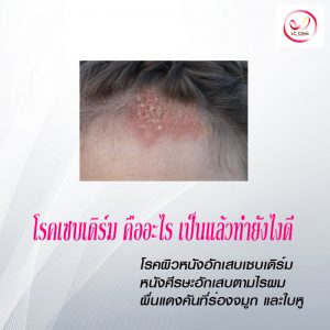 โรคเซบเดิร์ม Seborrheic Dermatitis ผิวหนังอักเสบ ที่ร่องจมูก หู หนังศีรษะ