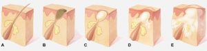 ขนคุด ผิวเป็นหนังไก่ (Keratosis Pilaris) คืออะไร รักษายังไงดีน่าา