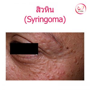 สิวหิน (Syringoma) คืออะไร รักษาได้ด้วยจี้ไฟฟ้า และเลเซอร์