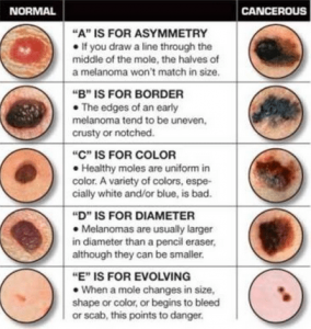 ไฝ (Nevus) คืออะไร รักษา กำจัดได้ด้วยเลเซอร์ จี้ไฟฟ้า และผ่าตัดเล็ก