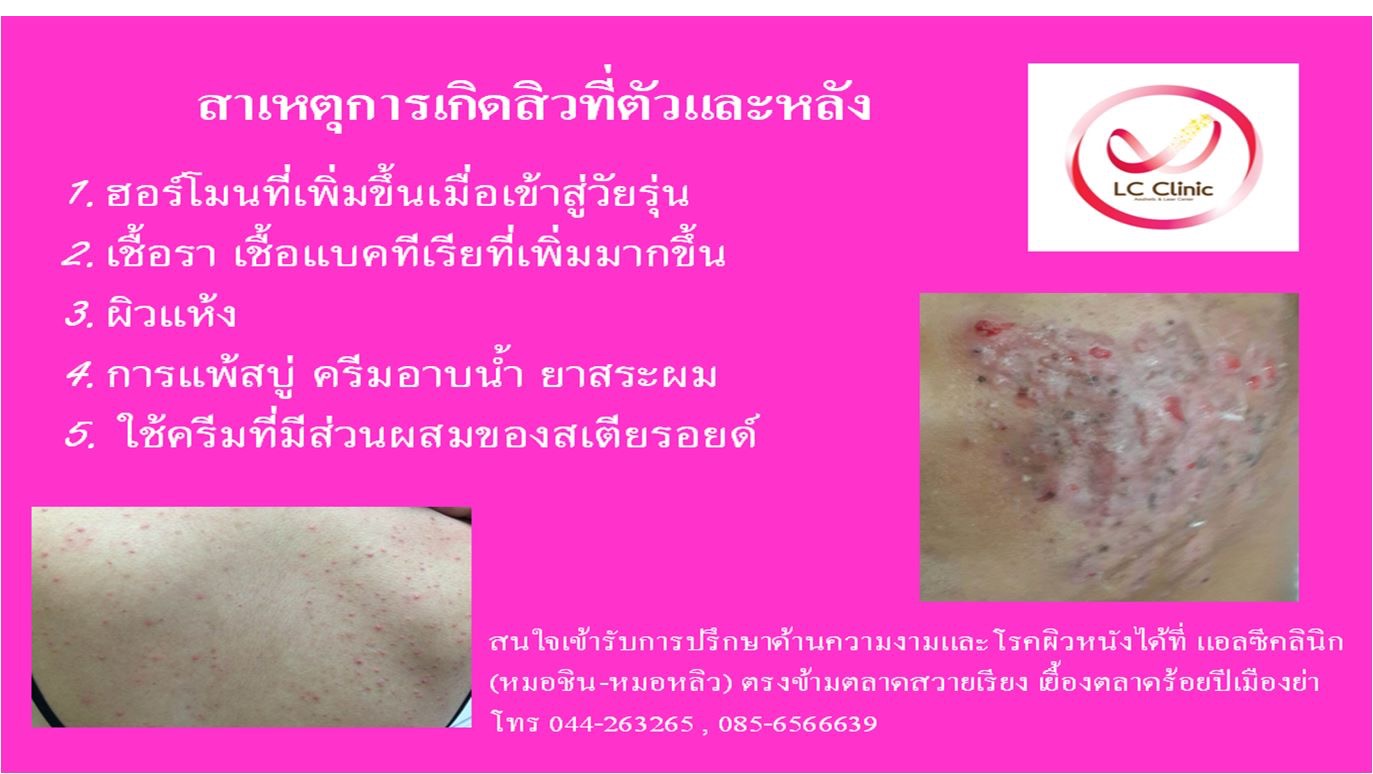 สิวที่ตัว สิวที่หลัง เกิดจากอะไร รักษายังไงดีน่า