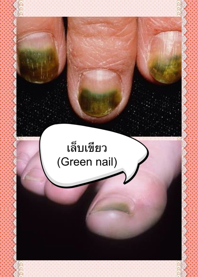 เล็บเขียว (Green nail)