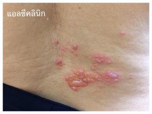 โรคงูสวัด (Herpes Zoster) เกิดจากอะไร อาการ และการรักษา