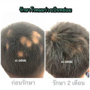 ผมร่วงเป็นหย่อม โรคผมร่วงเป็นหย่อม (Alopecia areata) รักษา ผมร่วง ผมบาง โรคหนังศีรษะ