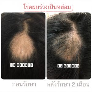 ผมร่วงเป็นหย่อม โรคผมร่วงเป็นหย่อม (Alopecia areata)