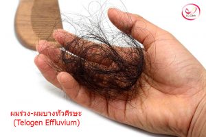 ผมร่วงทั่วศีรษะ Telogen Effluvium คืออะไร อาการ การรักษา