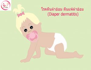 โรคผื่นผ้าอ้อม ผื่นแพ้ผ้าอ้อม (Diaper dermatitis) คืออะไร การรักษา