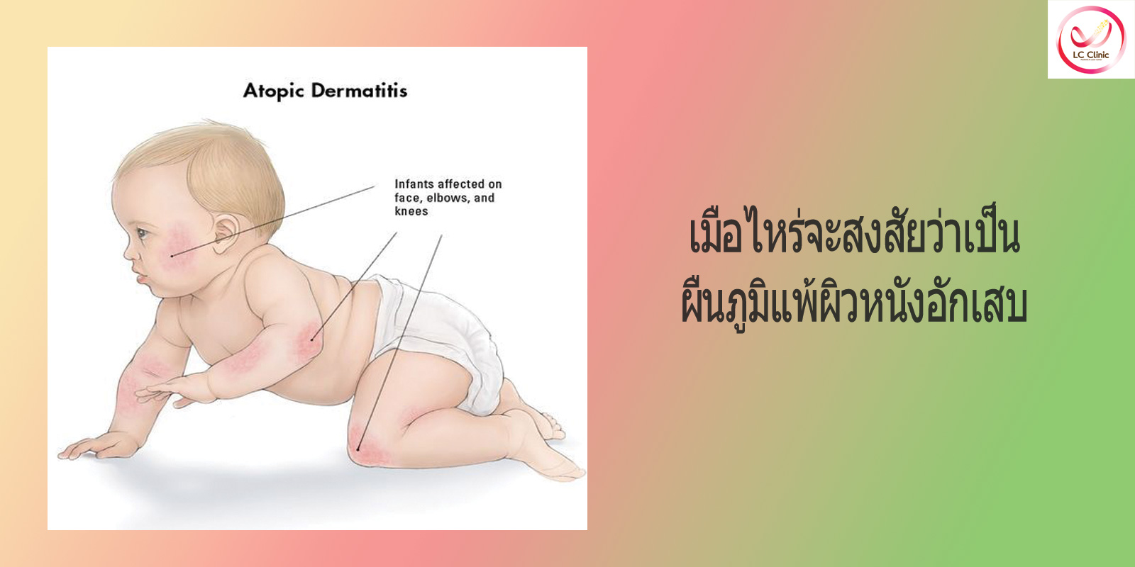 โรคผื่นภูมิแพ้ผิวหนังอักเสบ (Atopic Dermatitis)
