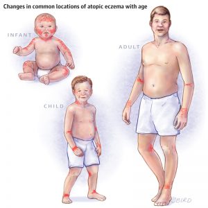 โรคผื่นภูมิแพ้ผิวหนัง (Atopic Dermatitis) อาการเป็นยังไง