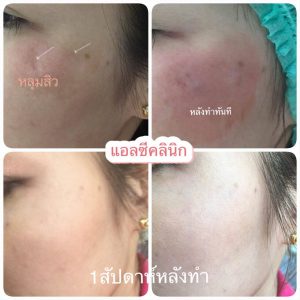 ฟิลเลอร์หลุมสิว การรักษาหลุมสิวด้วยสารเติมเต็ม เห็นผลทันทีหลังทำ