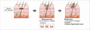 การเกิดแผลเป็นชนิดต่างๆ แผลเป็นหลุม แผลเป็นนูน แผลเป็นนูน คีลอยด์ Keloid คืออะไร