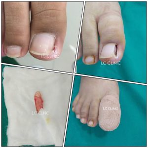 เล็บขบ (Ingrown nail) เกิดจากอะไร รักษายังไงดีน่า