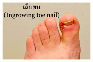 เล็บขบ Ingrown nail เกิดจากอะไร รักษายังไงดีน่า