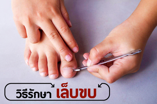 เล็บขบ (Ingrown nail) เกิดจากอะไร รักษายังไงดีน่า