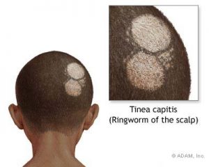โรคกลาก เชื้อรา บนหนังศีรษะ (Tinea Capitis) สาเหตุ อาการ การรักษา
