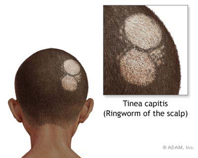 โรคกลาก เชื้อราบนหนังศีรษะ (Tinea Capitis) สาเหตุ อาการ และการรักษา