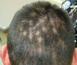 โรคกลาก เชื้อรา บนหนังศีรษะ (Tinea Capitis) สาเหตุ อาการ การรักษา