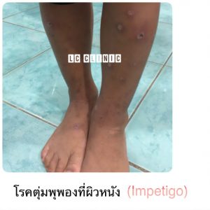 โรคตุ่มพุพอง (Impetigo) ตุ่มแผลพุพอง ตุ่มหนองที่ขา คลินิก ตรวจรักษา โรคผิวหนังเด็ก ผื่นภูมิแพ้ผิวหนัง ผื่นคัน ลมพิษ