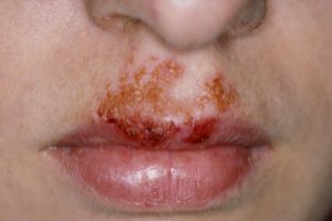 โรคตุ่มพุพอง Impetigo แผลพุพอง คืออะไร  สาเหตุ อาการ การวินิจฉัย การรักษา