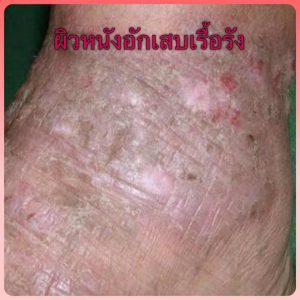 โรคผิวหนังอักเสบ (Eczema) ผิวหนังอักเสบเรื้อรัง Lichen Simplex Chronicus คืออะไร สาเหตุ อาการ การรักษา