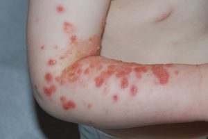 โรคตุ่มพุพอง Impetigo แผลพุพอง คืออะไร  สาเหตุ อาการ การรักษา