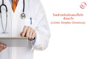 ผิวหนังอักเสบเรื้อรัง Lichen Simplex Chronicus คืออะไร สาเหตุ อาการ การรักษา