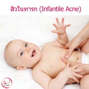 สิวในทารก Infantile acne คืออะไร สาเหตุ อาการ การรักษา