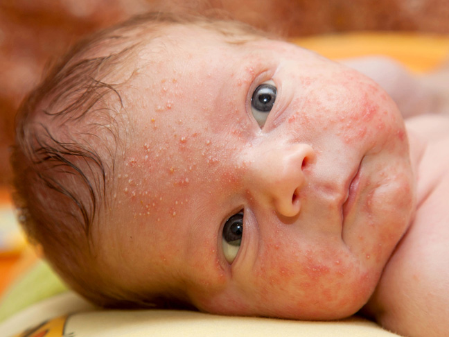 สิวในทารก (Infantile acne) คืออะไร อาการ และการรักษา