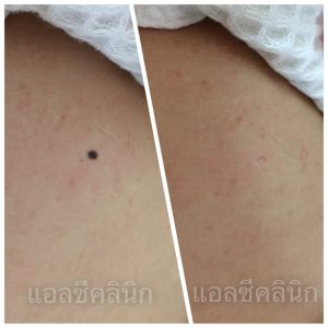 ไฝ (Nevus) คืออะไร รักษา กำจัดได้ด้วยเลเซอร์ จี้ไฟฟ้า และผ่าตัดเล็ก