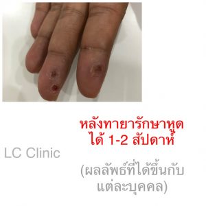 หูด (Wart) สาเหตุ อาการ และการรักษาโรคหูดที่ผิวหนัง