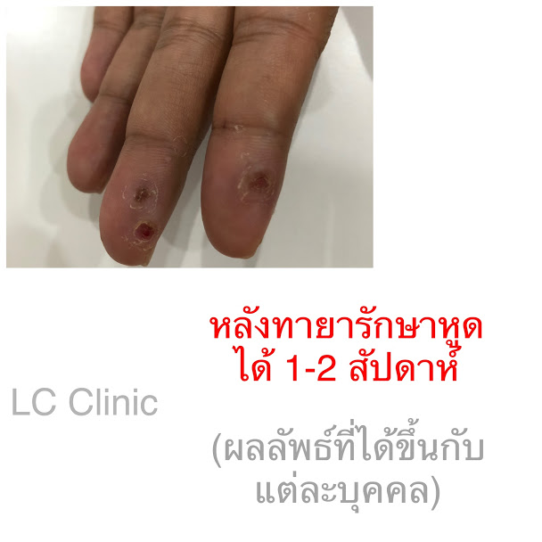 หูด (Wart) สาเหตุ อาการ และการรักษาโรคหูดที่ผิวหนัง