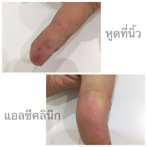 การรักษาหูด ที่ผิวหนัง มีวิธีอะไรบ้าง ยาทา จี้เย็น เลเซอร์ และการผ่าตัด