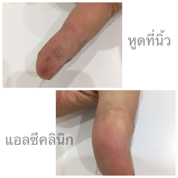 หูด (Wart) สาเหตุ อาการ และการรักษาโรคหูดที่ผิวหนัง