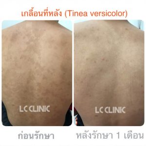 โรคเกลื้อน Pityriasis Versicolor คืออะไร สาเหตุ อาการ การรักษา