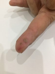 หูด (Wart) สาเหตุ อาการ และการรักษาโรคหูดที่ผิวหนัง