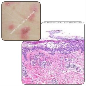 โรคตุ่มน้ำพองใสจากภูมิคุ้มกัน (Vesiculobullous disease)