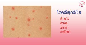 โรคอีสุกอีใส chickenpox รักษายังไง สาเหตุ อาการ การรักษา