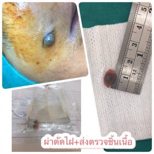 การตัดชิ้นเนื้อผิวหนัง (Skin Biopsy) ส่งตรวจเพื่อวินิจฉัยโรคผิวหนัง