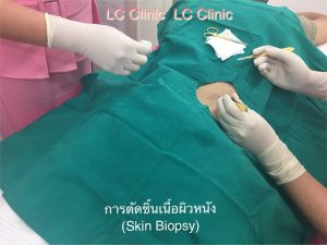 การตัดชิ้นเนื้อผิวหนัง (Skin Biopsy) ส่งตรวจเพื่อวินิจฉัยโรคผิวหนัง โรคตุ่มน้ำพองใสจากภูมิคุ้มกัน (Vesiculobullous disease) คืออะไร