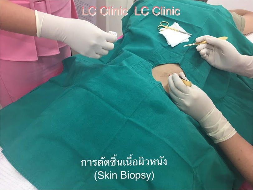 การตัดชิ้นเนื้อผิวหนัง (Skin Biopsy) ส่งตรวจเพื่อวินิจฉัยโรคผิวหนัง