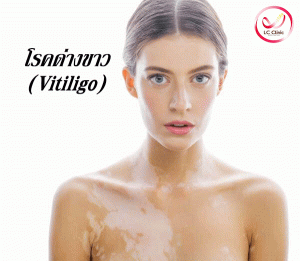 โรคด่างขาว (Vitiligo) คืออะไร สาเหตุ อาการ และการรักษา