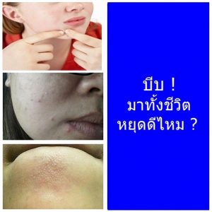 สิว จากแพ้เครื่องสำอาง (Acne Cosmetica) สิวพบบ่อยในผู้ใหญ่ คืออะไร รักษายังไง